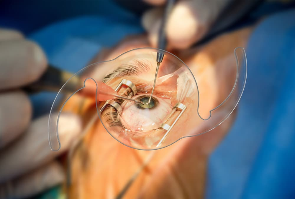 Cataract surgery setting with representation of a premium intraocular lens